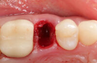 Extraction Socket – Preservation/Grafting; Immediate vs Delayed Implants; Pontic Site Development