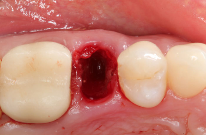 Extraction Socket – Preservation/Grafting; Immediate vs Delayed Implants; Pontic Site Development