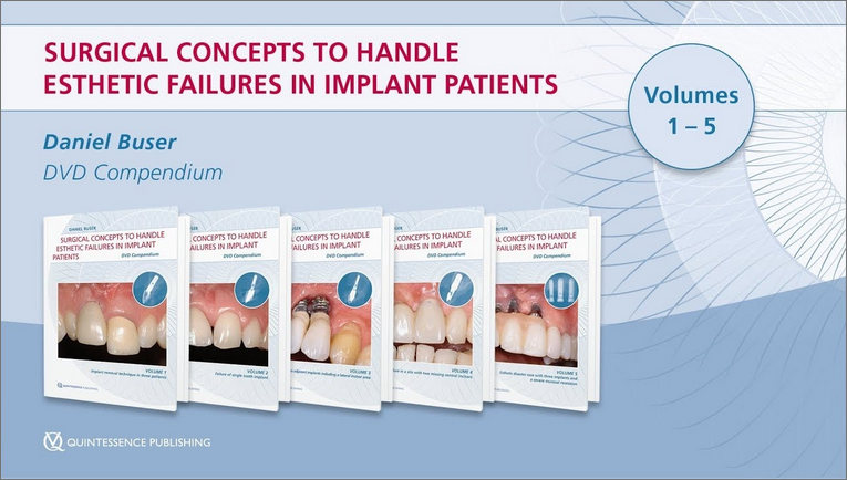 Surgical concepts to handle esthetic failures in implant patients