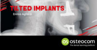 Tilted Implants: A Complete Surgical and Theoretical Guide to Tilted Implants