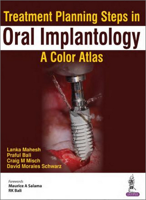 Treatment Planning Steps in Oral Implantology: A Color Atlas