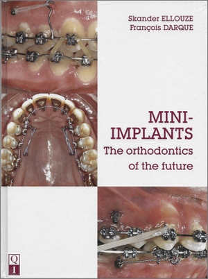 MINI-IMPLANTS: The Orthodontics of the Future