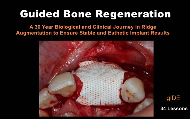 Guided Bone Regeneration – a 30-year Biological and Clinical Journey in Ridge Augmentation to Ensure Stable and Esthetic Implant Results