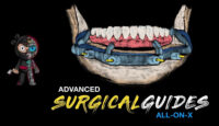 Implant Ninja, Advanced Surgical Guides – All on X
