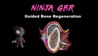 Implant Ninja, Guided Bone Regeneration