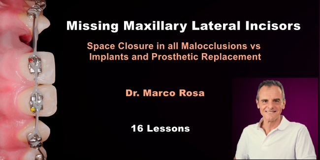 Missing maxillary lateral incisors: space closure in all malocclusions vs implants and prosthetic replacement