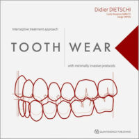 Tooth Wear: Interceptive Treatment Approach with Minimally Invasive Protocols