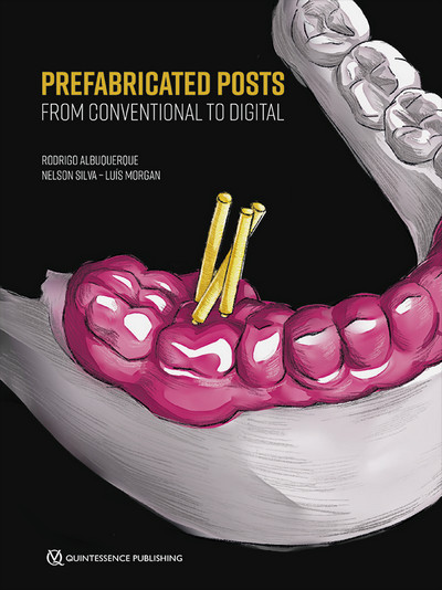 Prefabricated Posts: From Conventional to Digital Prefabricated Posts: From Conventional to Digital